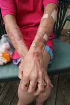 ###NEWS - HIV-positive - Ocala - CONTACT PHOTOGRAPHER 352-598-7976 - cell### A woman known only as "Dee" shows her arms that are covered with bruises due to low white cell count. She is HIV-positive, Friday afternoon, June 24, 2005, in Ocala, FL. (Jannet Walsh/Star-Banner)2005